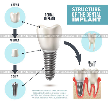 Dental Implant Structure Medical Infographic Poster . Dental implant structure medical pictorial educative infographic poster with molar replacement end healthy tools models vector illustration . Стоковая иллюстрация, агентство Ingram Publishing / Фотобанк Лори