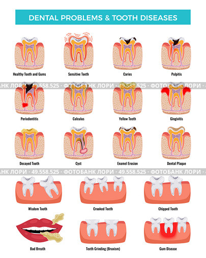 Dental oral problems educational infographic set with caries inflammation tooth plaque bad breath enamel erosion vector illustration. Стоковая иллюстрация, агентство Ingram Publishing / Фотобанк Лори