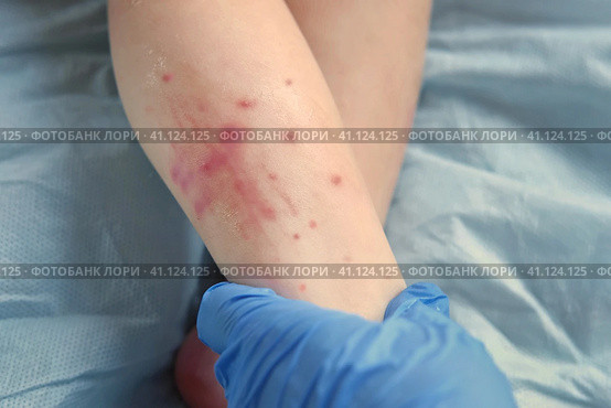 Doctor hands examining infant leg. Little Kid allergy. Closeup. Child scratches a red rash. Nurse applies a special cream to atopic skin. Dermatitis, diathesis, irritation on the baby body. Pruritus. Стоковое фото, фотограф Марина Демидюк / Фотобанк Лори