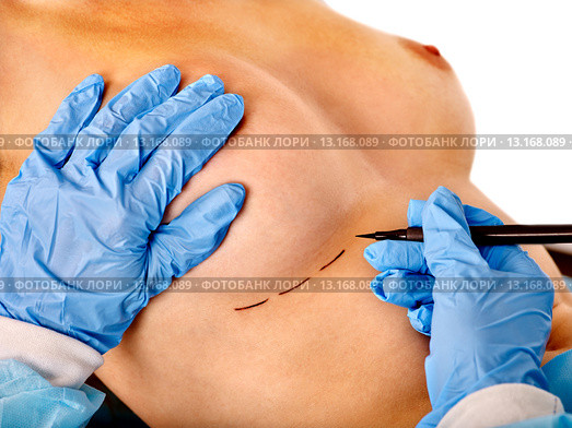 Doctor makes dotted line on female breast . Стоковое фото, фотограф Gennadiy Poznyakov / Фотобанк Лори