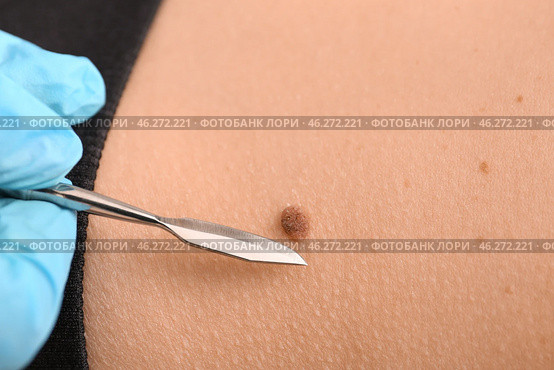 Doctor with lancet going to remove mole from patient's skin, closeup. Стоковое фото, фотограф Pixel_shot / Фотобанк Лори