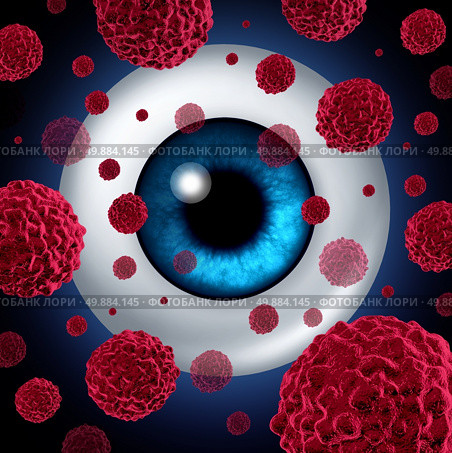 Eye cancer concept or intraocular cancers symbol as a human eyeball with cancerous cells spreading as a health care and medical icon for ocular tumor risk resulting in vision loss and blindness. Стоковое фото, агентство Ingram Publishing / Фотобанк Лори