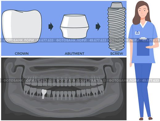 Female doctor talking about dental prosthesis structure. Implantation dentistry, stomatology. Tooth care, treatment. Dental implant creation scheme. Sequence of connection of screw, abutment and crown. Female doctor talking about prosthesis structure. Dentist works with dental implant creation scheme. Стоковая иллюстрация, агентство Ingram Publishing / Фотобанк Лори