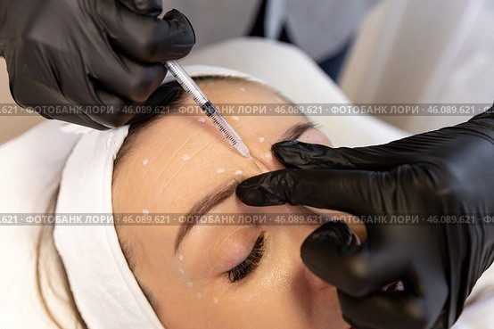 Filling of wrinkles, crow's feet, injection of botox. Portrait of a white woman during surgery filling facial wrinkles, Cosmetic is injected into facial skin cosmetics. Стоковое фото, фотограф Ирина Михайличенко / Фотобанк Лори