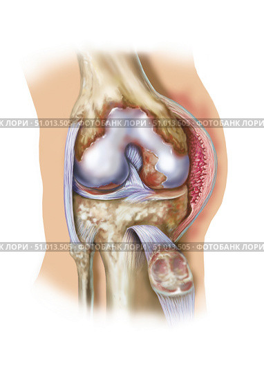 Front view of knee joint opened to show pannus. Стоковое фото, фотограф Elise Walmsley-MacWha/Stocktrek Images / ТАСС / Фотобанк Лори