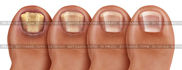 Fungal nail infection recovery diagram and onychomycosisor tinea unguium treatment as an infected foot toenail or toe nail with damaged unhealthy and healthy human anatomy in a 3D illustration style. Стоковое фото, агентство Ingram Publishing / Фотобанк Лори