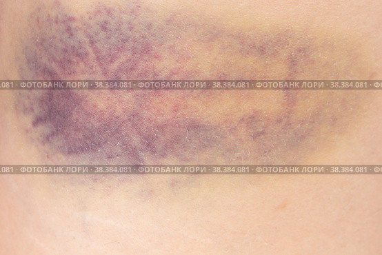 Hematoma on a woman thigh after a bruise or contusion. Стоковое фото, фотограф Андрей С / Фотобанк Лори