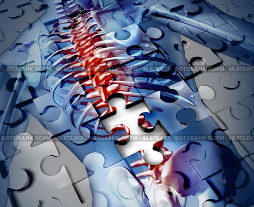 Human back disease medical concept with a jigsaw puzzle texture and a piece missing as a broken skeleton anatomy and a symbol of the spine and joint pain caused by inflamation. Стоковое фото, агентство Ingram Publishing / Фотобанк Лори