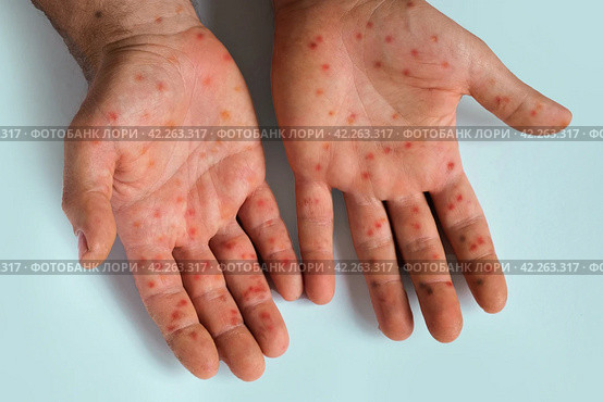 Human Hands with Painful Rash, Red Spots Blisters on the Skin. Health Problem. Monkeypox Disease Symptoms. Male Patient Arms with Monkey Pox. Close Up. Banner, Copy Space. Dengue Fever Infection, MPOX. Стоковое фото, фотограф Марина Демидюк / Фотобанк Лори