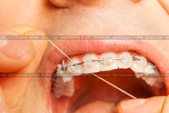Man with braces on teeth using dental floss. Стоковое фото, фотограф Сергей Новиков / Фотобанк Лори