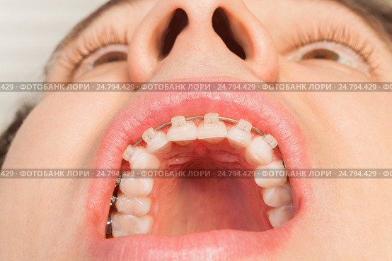 Man's wide opened mouth with dental braces. Стоковое фото, фотограф Сергей Новиков / Фотобанк Лори