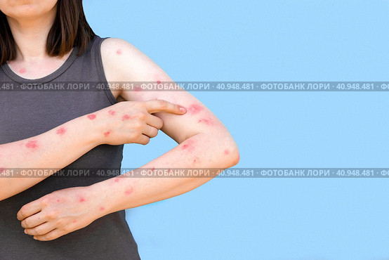 Monkeypox new disease dangerous over the world. Patient with Monkey Pox. Painful rash, red spots blisters on the hand. Close up rash, human hands with Health problem. Banner, copy space. Стоковое фото, фотограф Марина Демидюк / Фотобанк Лори