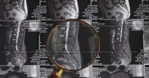 MRI lumbar spine background, magnetic resonance tomography. Doctor examines MRI of lumbar spine with pinched discs of spine and nerves. Стоковое видео, видеограф Андрей Армягов / Фотобанк Лори