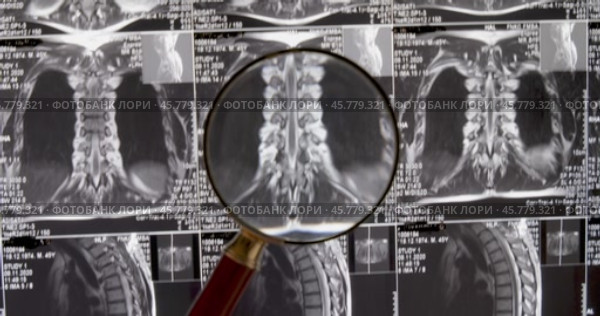 MRI lumbar spine background, magnetic resonance tomography. Doctor examines MRI of lumbar spine with pinched discs of spine and nerves. Стоковое видео, видеограф Андрей Армягов / Фотобанк Лори