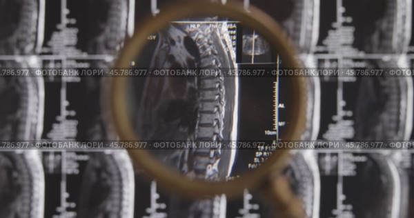 MRI lumbar spine background, magnetic resonance tomography. Doctor examines MRI of lumbar spine with pinched discs of spine and nerves. Стоковое видео, видеограф Андрей Армягов / Фотобанк Лори