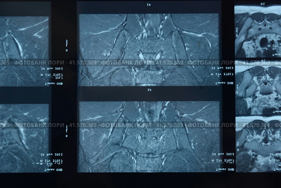 MRI sacroiliac articulation. Study of ankylosing spondyloarthritis patient. Стоковое фото, фотограф Леонид Еремейчук / Фотобанк Лори
