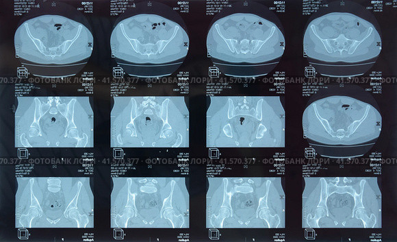 MRI sacroiliac articulation. Study of ankylosing spondyloarthritis patient. Стоковое фото, фотограф Леонид Еремейчук / Фотобанк Лори