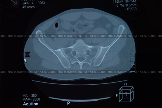 MRI sacroiliac articulation. Study of ankylosing spondyloarthritis patient. Стоковое фото, фотограф Леонид Еремейчук / Фотобанк Лори