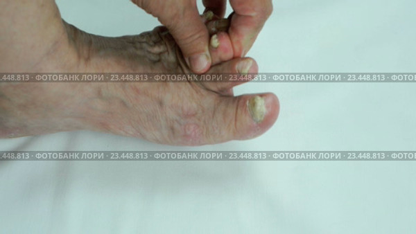 Ногти женщины с грибковой инфекцией. Стоковое видео, видеограф worker / Фотобанк Лори