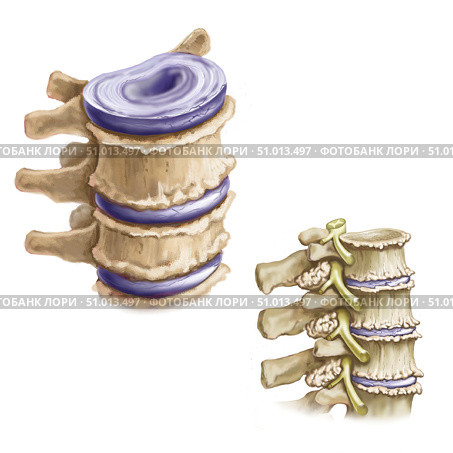 Osteoarthritic spurs on vertebral column. Стоковое фото, фотограф Elise Walmsley-MacWha/Stocktrek Images / ТАСС / Фотобанк Лори