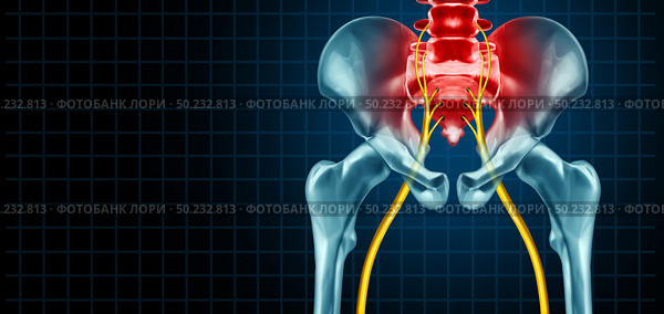 Painful sciatica nerve symptom and pain diagnosis as a medical concept for a disease causing physical problems with 3D illustration elements. Стоковое фото, агентство Ingram Publishing / Фотобанк Лори