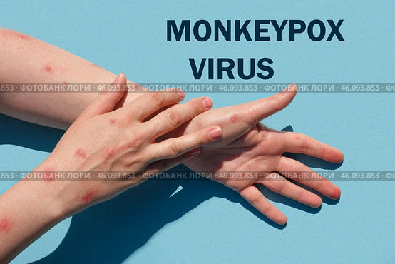 Phrase MONKEYPOX VIRUS on blue background and Patient with Monkey Pox. Monkeypox new disease dangerous over the world. Painful rash, red spots blisters. Close up human hands with Health problem. Стоковое фото, фотограф Марина Демидюк / Фотобанк Лори