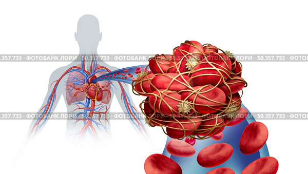Pulmonary Embolism illness with a blood clot as a disease with a blockage of an artery in the lungs with 3D illustration elements. Стоковое фото, агентство Ingram Publishing / Фотобанк Лори