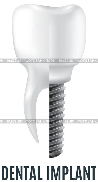 Realistic white dental implant and human tooth. Dentistry, medicine and oral cavity health concept. Denture construction, dental prosthesis structure. Information banner about teeth and implants. Realistic white dental implant and human tooth. Dentistry, medicine and oral cavity health. Стоковая иллюстрация, агентство Ingram Publishing / Фотобанк Лори