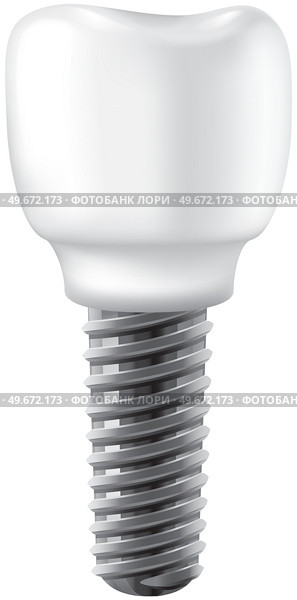 Realistic white dental implant, denture. Dentistry, medicine and health concept. Denture construction, dental implant. Instrument for replacement of diseased tooth. Screw retained for teeth implants. Instrument for replacement of diseased tooth. Screw dental implant, denture construction, prosthesis. Стоковая иллюстрация, агентство Ingram Publishing / Фотобанк Лори