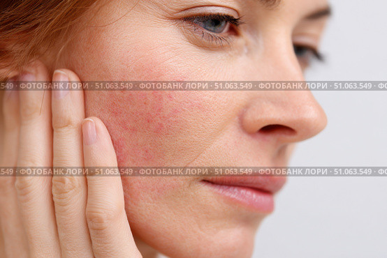 Sensitive skin. Woman scratches cheek with red rash, allergy symptom. Skin irritation, dermatitis, itchy skin problem. Face affected with Allergic reaction. Person suffering from itching, scratching. Стоковое AI-изображение, AI-художник Марина Демидюк / Фотобанк Лори