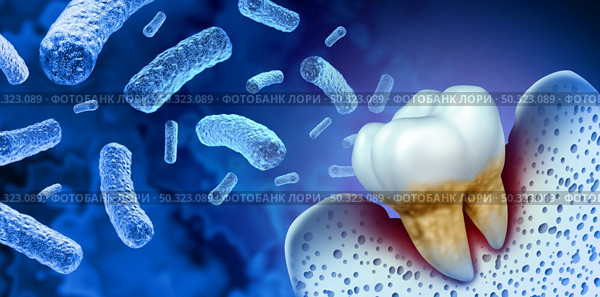 Tooth bacterial infection and teeth decay disease as an unhealthy molar with periodontitis due to poor oral hygiene health problem as an infectious bacteria concept with inflammation as a 3D illustration on a blue background. Стоковое фото, агентство Ingram Publishing / Фотобанк Лори