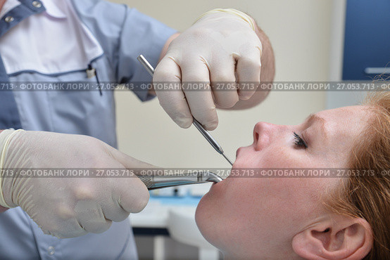 Tooth Extraction procedure with forceps, closeup portrait of woman patient during operation in dentist clinic. Стоковое фото, фотограф Сергей Дорошенко / Фотобанк Лори