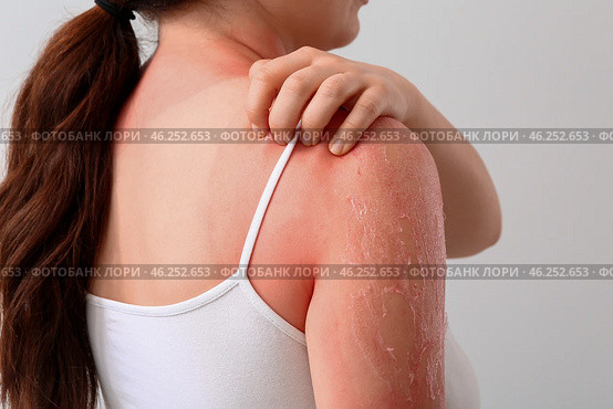 Woman with red sunburned skin against light background, closeup. Стоковое фото, фотограф Pixel_shot / Фотобанк Лори