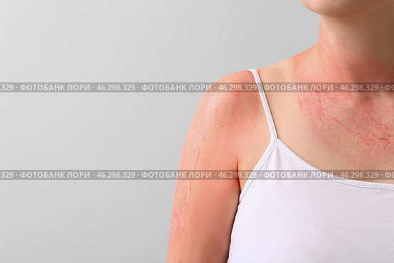 Woman with red sunburned skin against light background, closeup. Стоковое фото, фотограф Pixel_shot / Фотобанк Лори