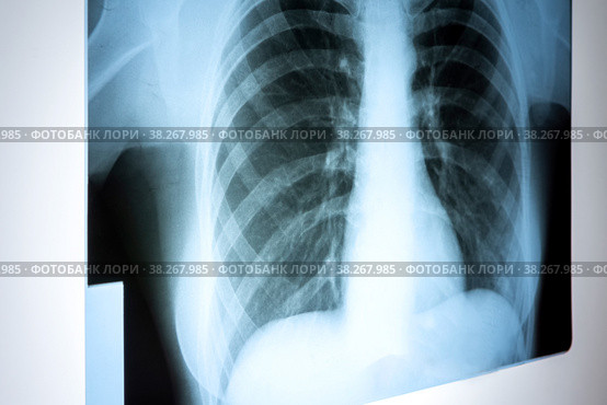 X-ray of the lungs. Chest x-ray. Viewing a picture of the lungs in the hospital on a reflective board,blurred focus. Стоковое фото, фотограф Светлана Акифьева / Фотобанк Лори