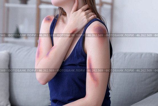 Young woman with bruised arms sitting on sofa at home, closeup. Стоковое фото, фотограф Pixel_shot / Фотобанк Лори